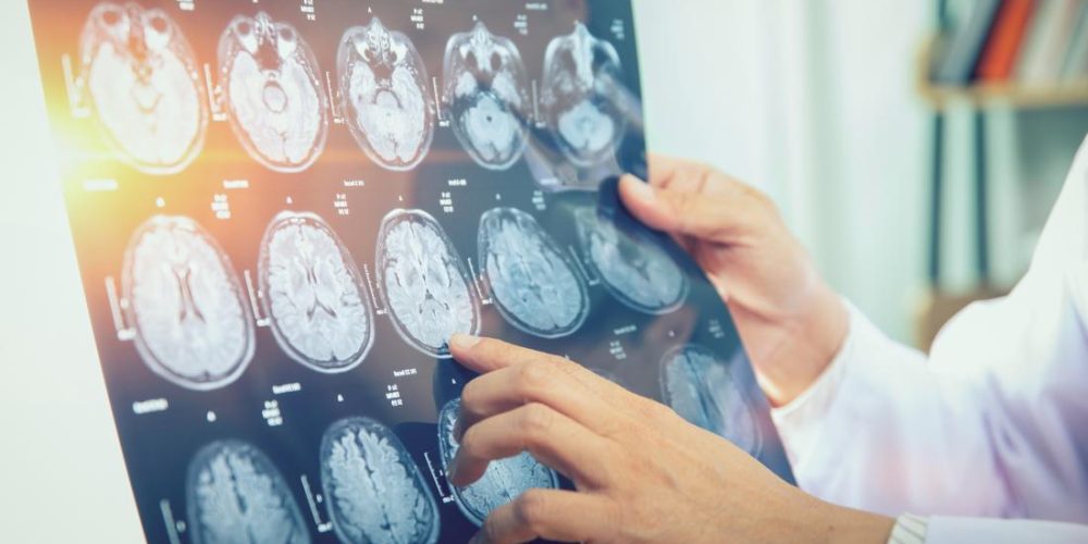 Brain cancer: Lithium may restore cognitive function after radiation