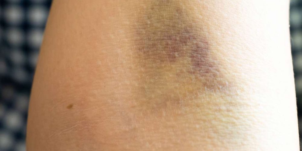 Bruising after a blood draw: What to know