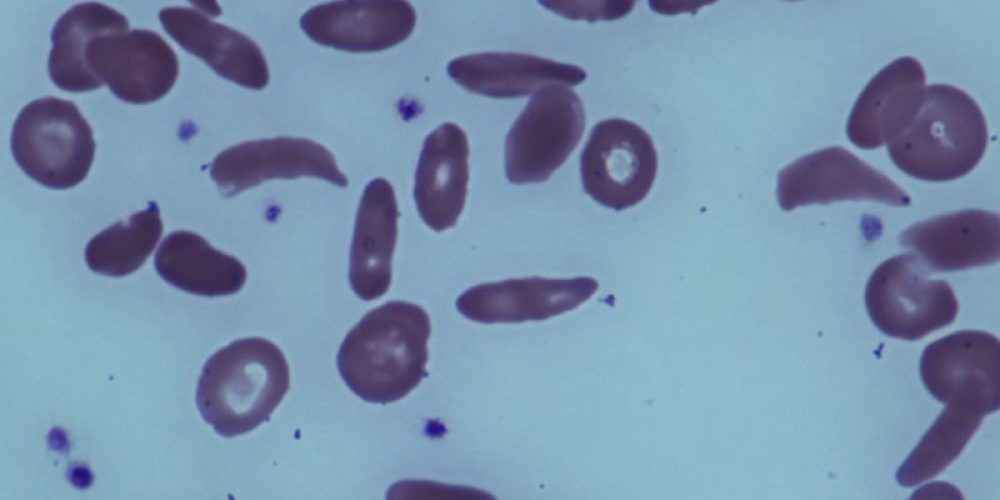 Experimental Drug Shows Early Promise Against Sickle Cell Disease