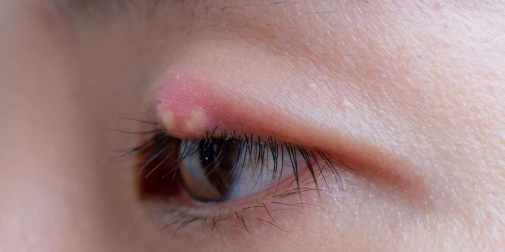 How to treat or get rid of a stye