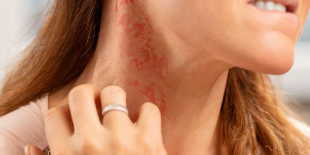 Itchy rash: 8 types