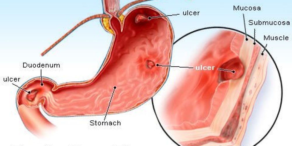Peptic Ulcer (Stomach Ulcer)