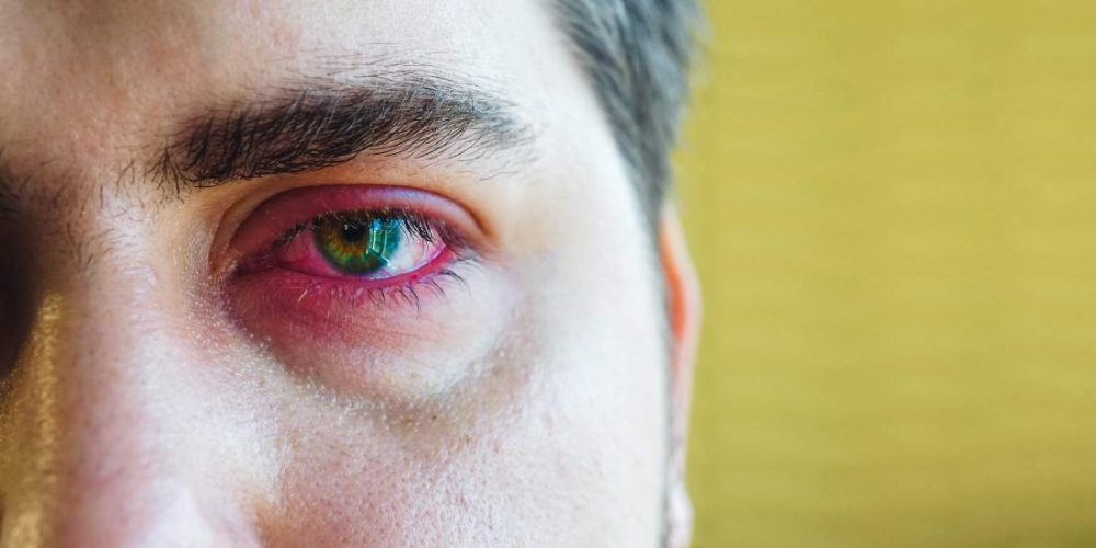 What can cause a sore eyelid?
