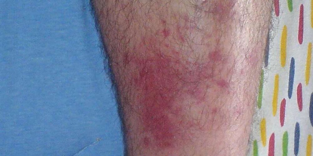 What to know about cellulitis from bug bites