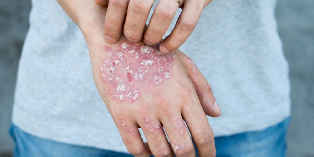 What to know about psoriasis and keratosis pilaris