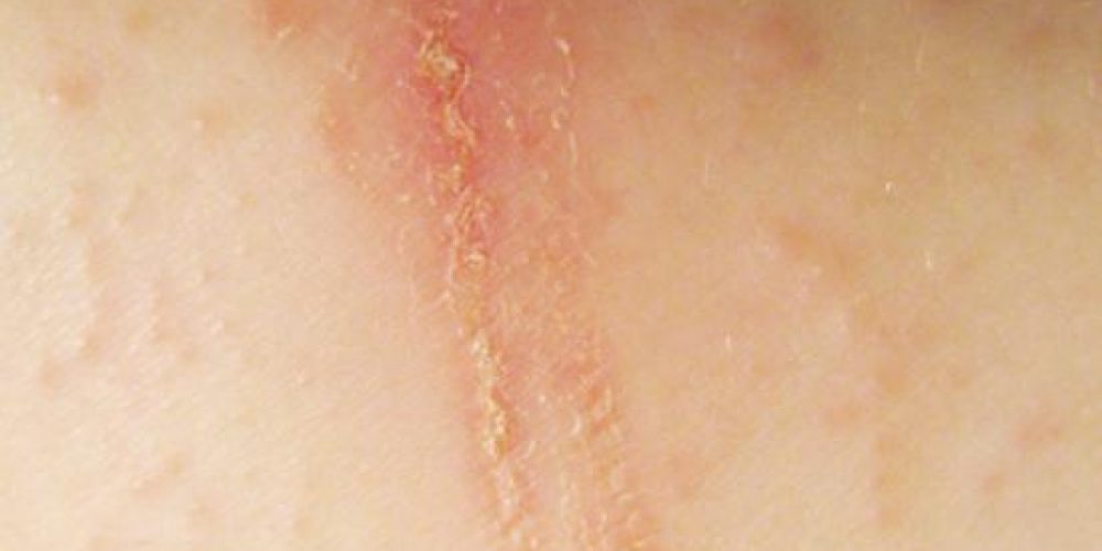 What causes patches of dry skin?