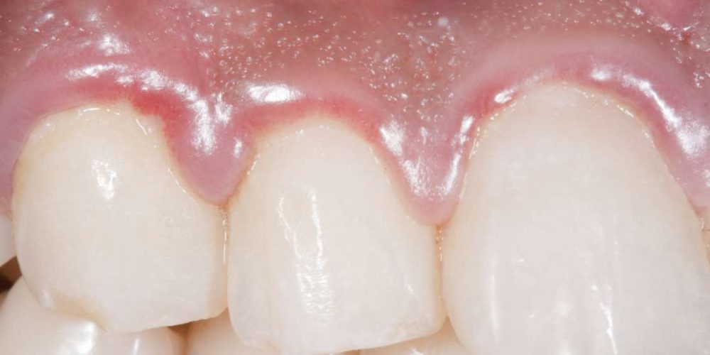 What to do about swollen gums