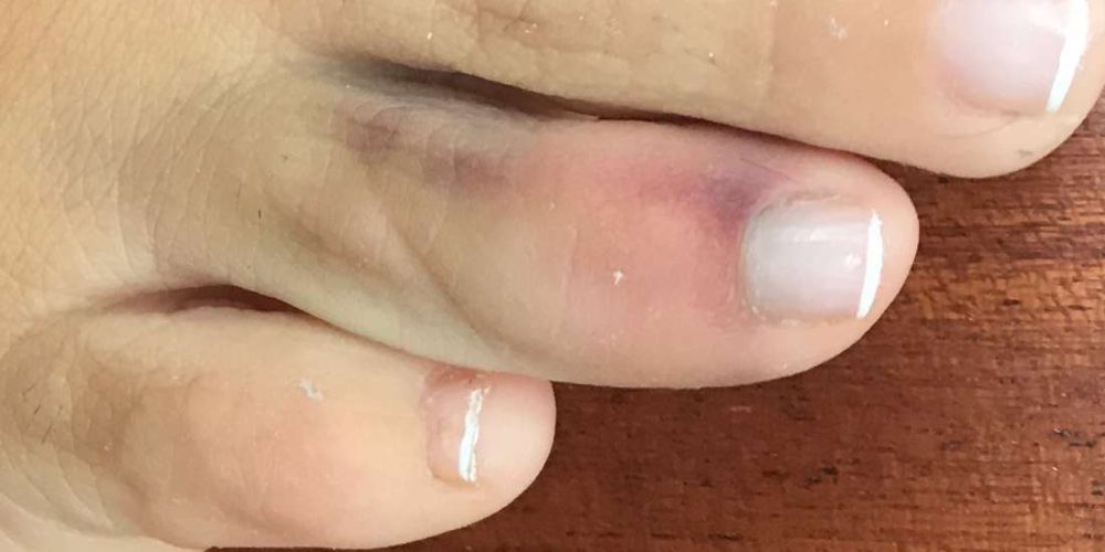 What to know about a sprained toe