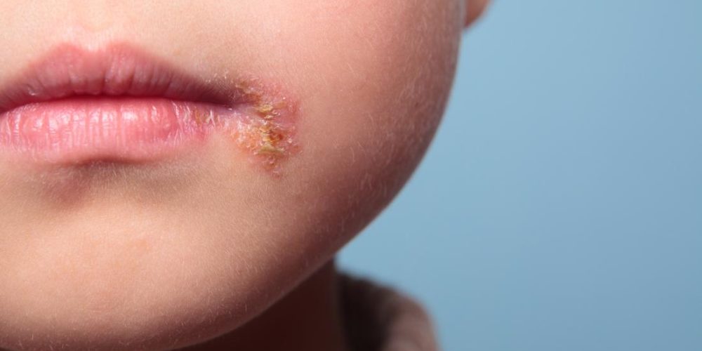 What to know about babies and cold sores