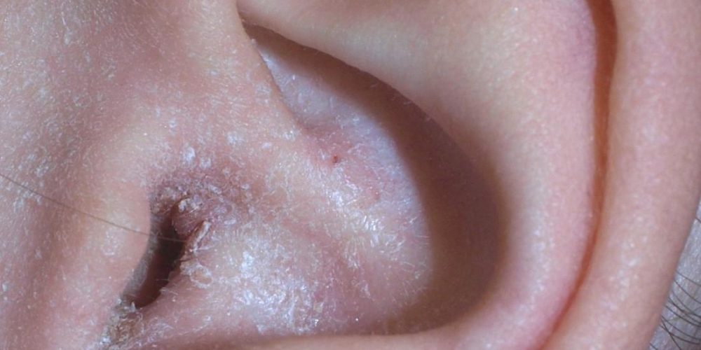 What to know about ear eczema