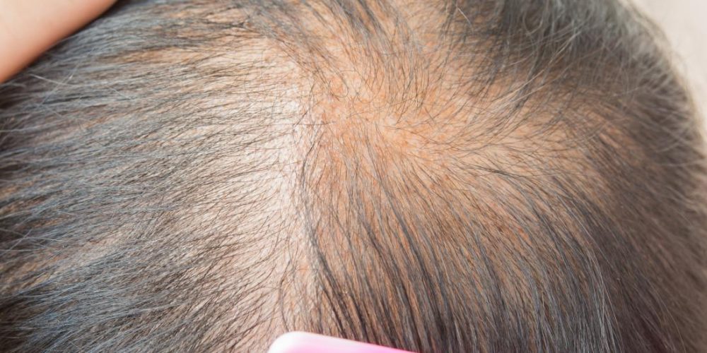 Causes and treatments for thinning hair