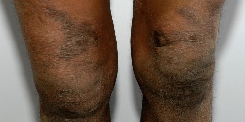 Eczema on black skin: What to know