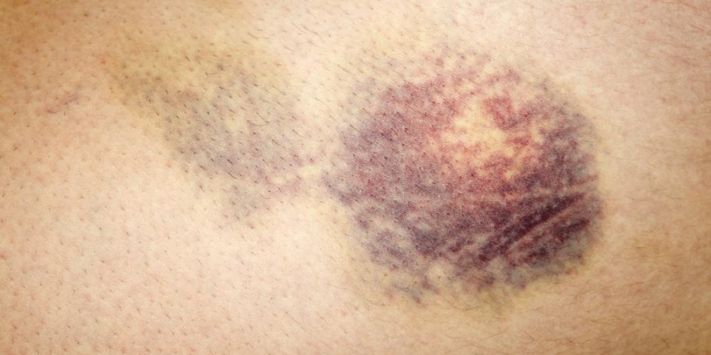 Hematoma: Everything you need to know