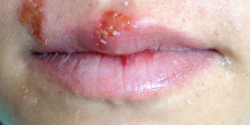 How to identify and treat a herpes skin rash