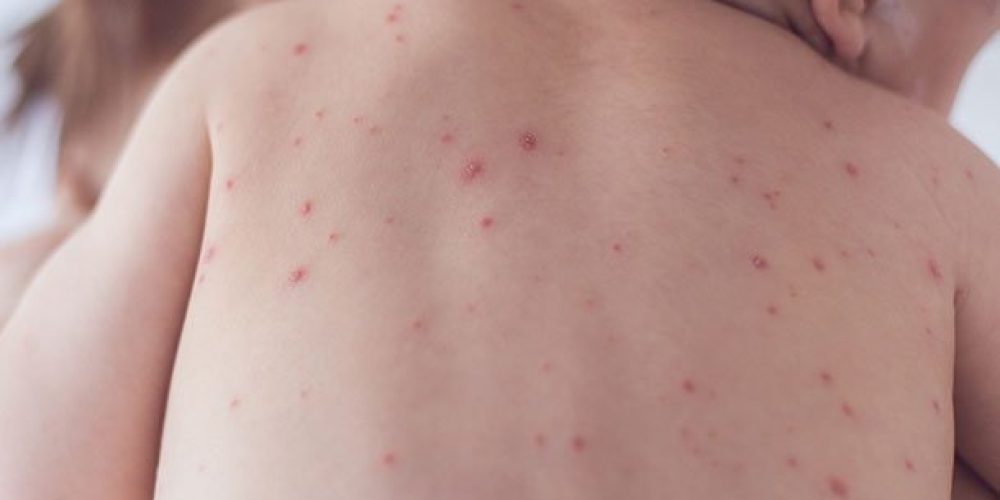 Measles Outbreak in Samoa Continues Due to Underimmunization