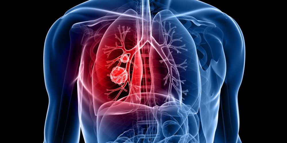 New protein may help to catch lung cancer early