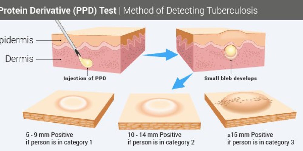 Tuberculosis Skin Test (PPD Skin Test)