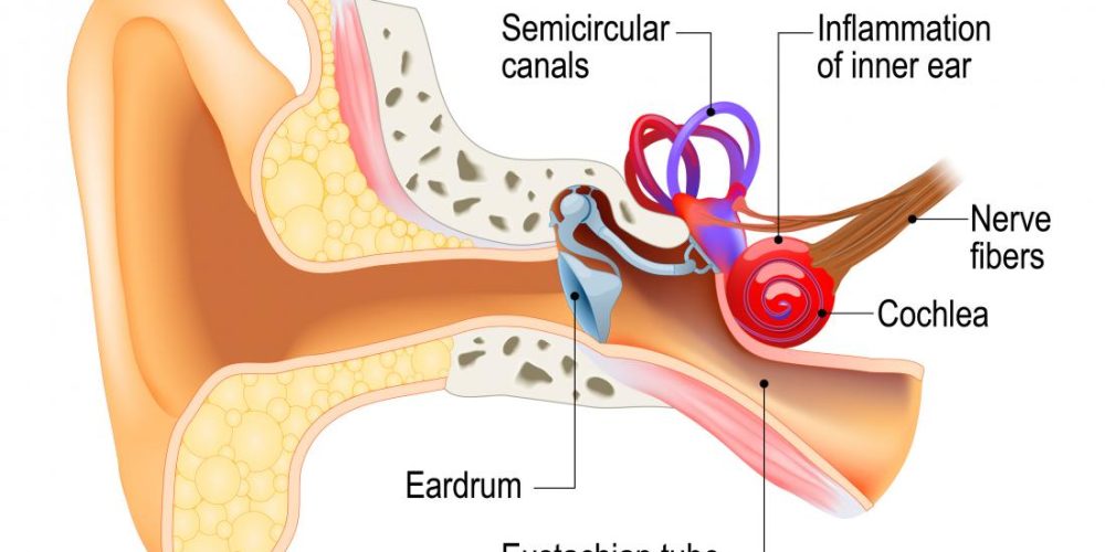 What is labyrinthitis?