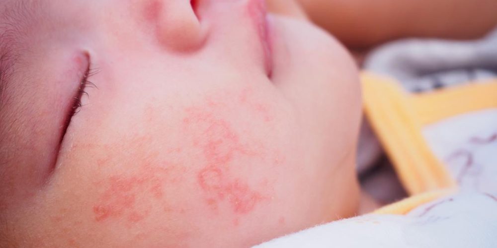 What to do if a baby has an allergic reaction