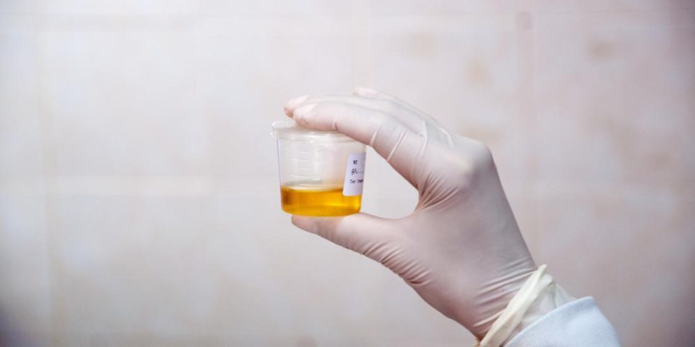 What to know about 24-hour cortisol urine tests