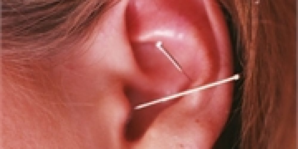 Acupuncture May Ease a Common Side Effect of Cancer Treatment