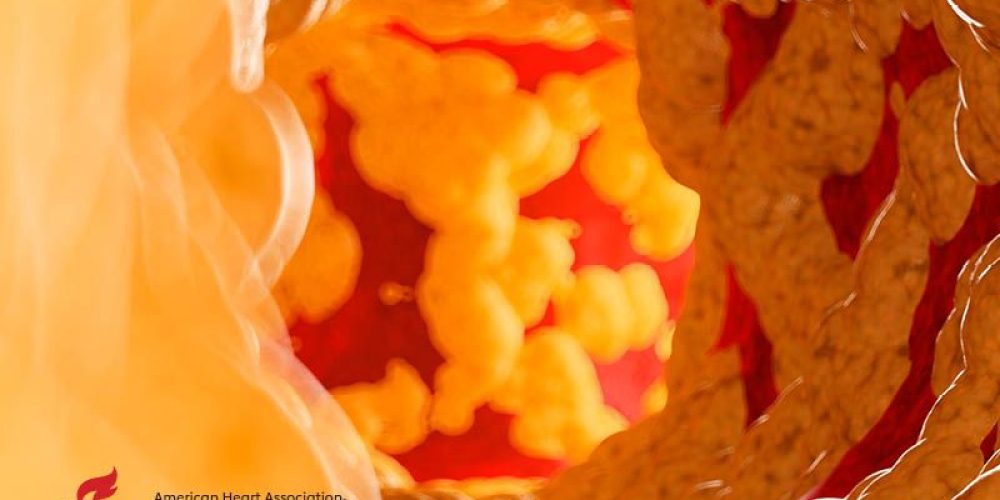 AHA News: More Clues to the Genetics Behind an Inherited Cholesterol Disorder