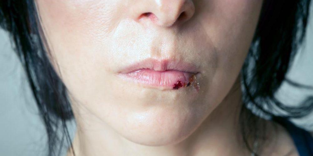 Causes and treatment of a split lip
