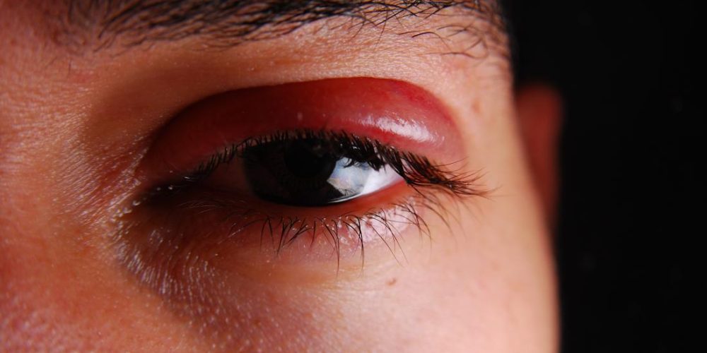 How can shingles affect the eyes?