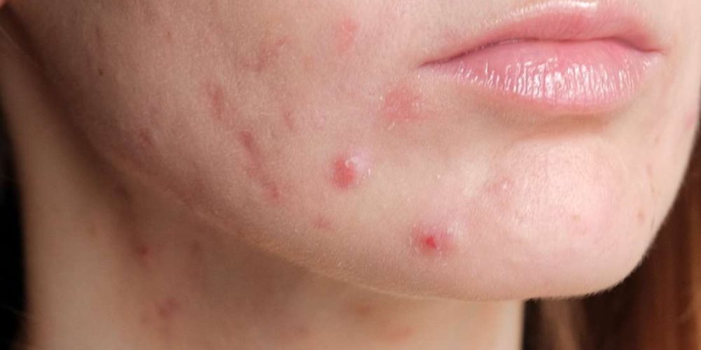 How to treat pregnancy acne