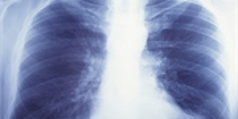 Lung Cancer Report Delivers Good, Bad News