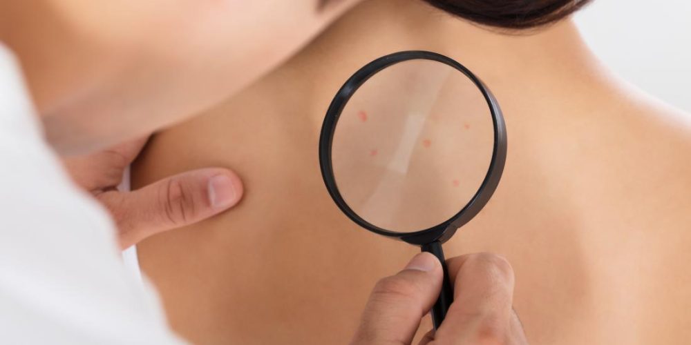 Skin cancer: Common IBD, arthritis drug may raise risk