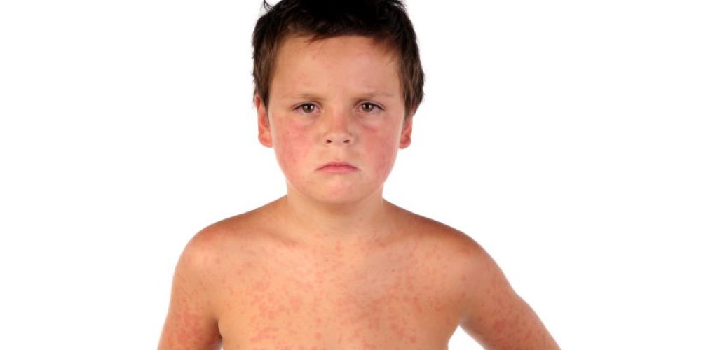 Texas Cities Are Ripe for Measles Outbreaks, Study Finds