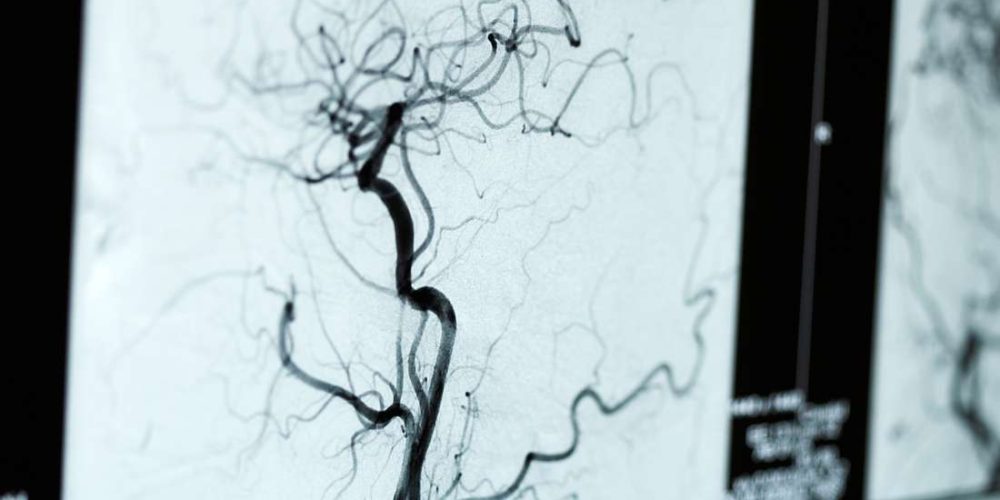 What to know about angiograms