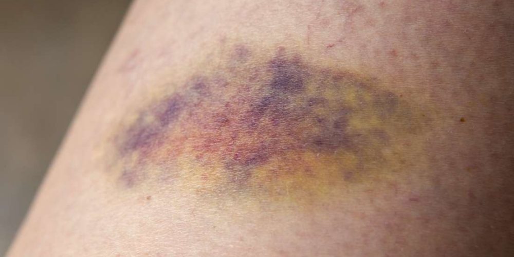 What to know about bruising easily