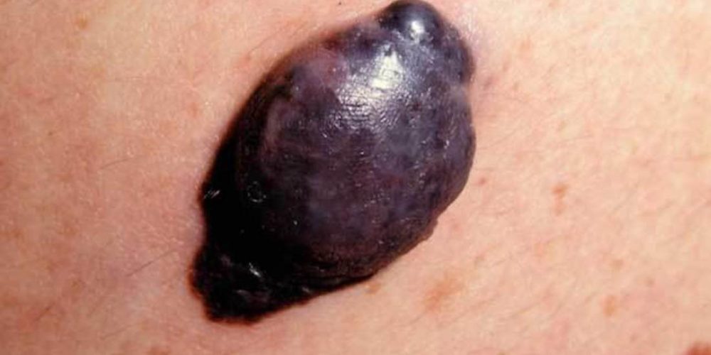 What to know about nodular melanoma