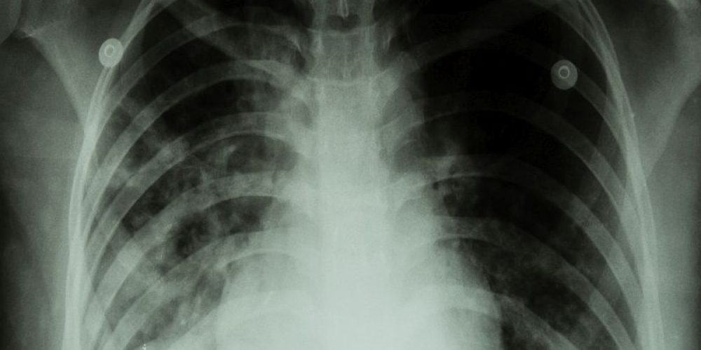 FDA Approves Drug for Most Deadly Form of TB
