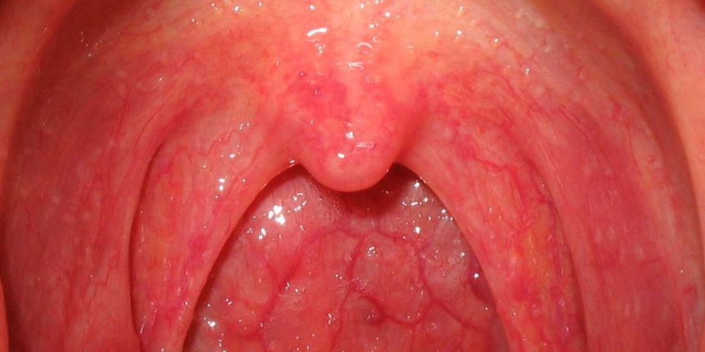 What causes bumps in the back of the throat?