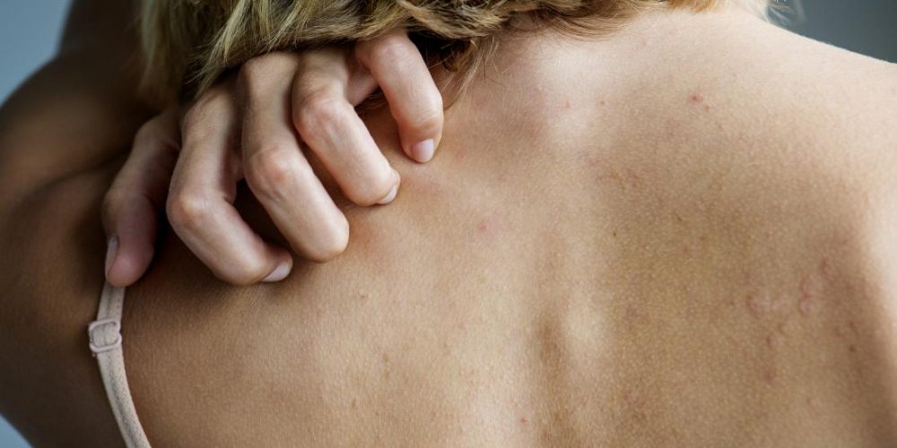 What to know about lichen planus and psoriasis