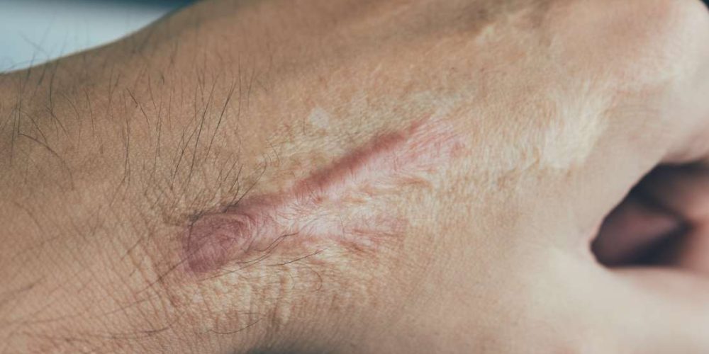 What to know about scar tissue