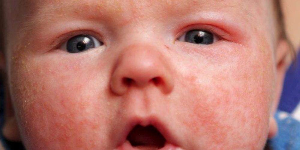 Why Some Kids With Eczema Are at Higher Allergy Risk