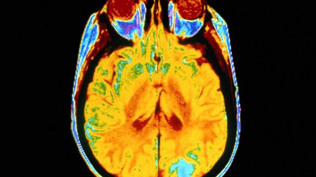 Brain Scans Spot, Track Alzheimer’s