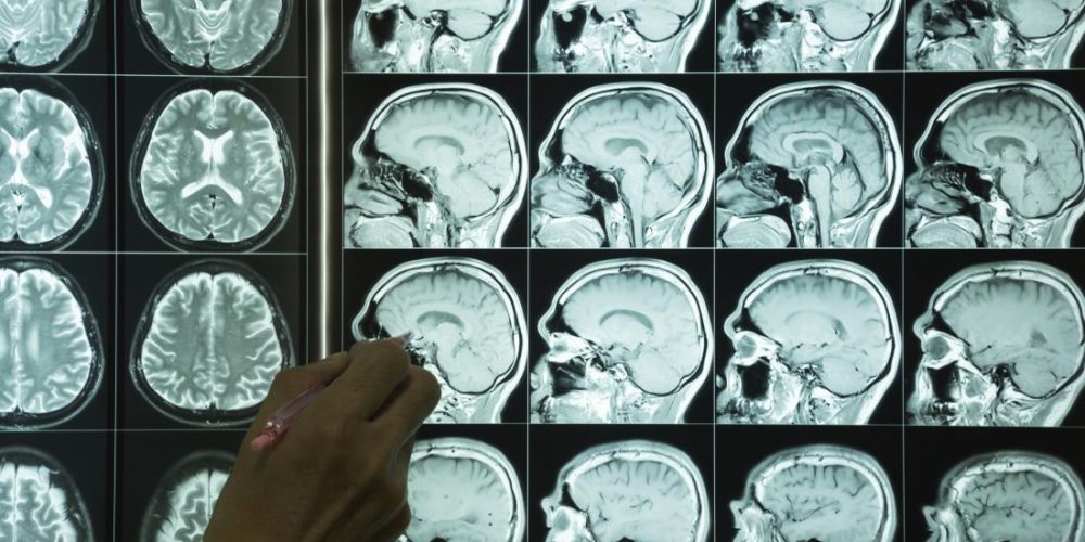 Dementia: Brain mapping method may predict progression
