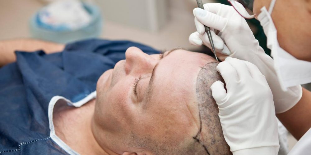 How effective are different hair transplant methods?