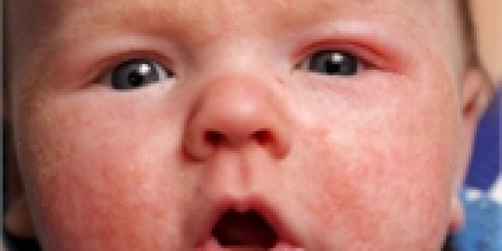 Infants May Not Be as Immune to Measles as Thought