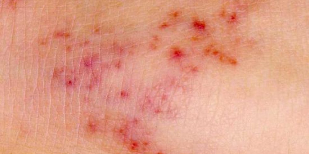 Meningitis rash: Pictures, symptoms, and test