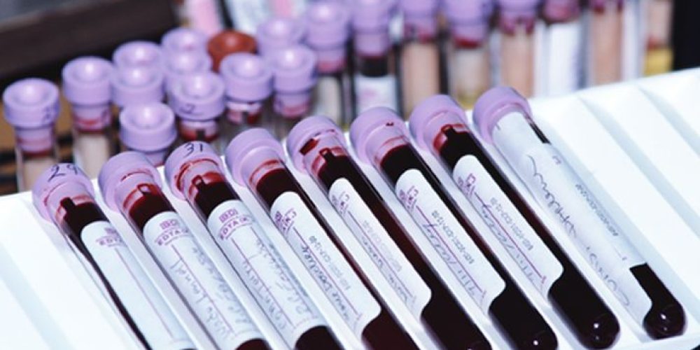 Most Americans Have Never Had an HIV Test: CDC