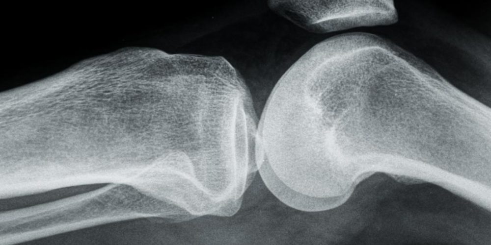 Osteoarthritis: Can an antioxidant offer protection?
