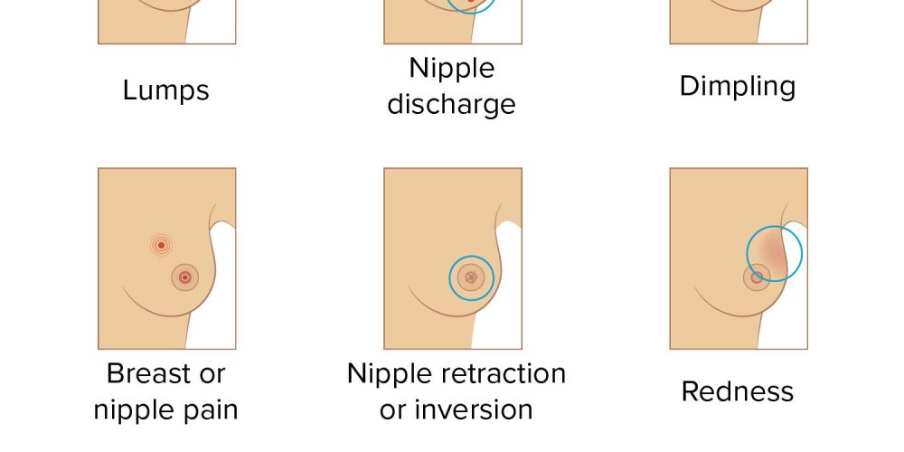 What are the symptoms of breast cancer?