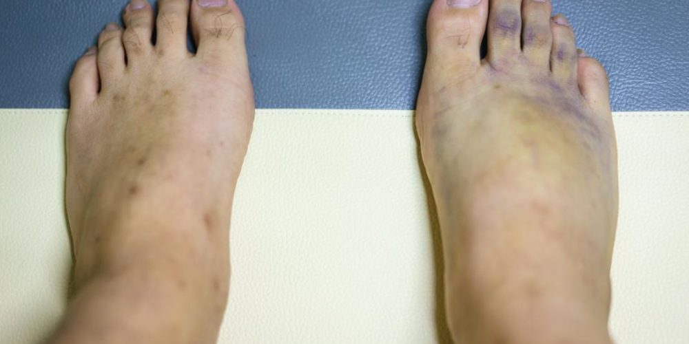 What causes purple feet?