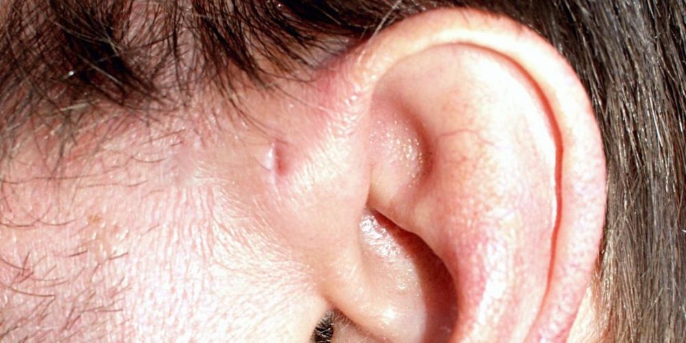 What is a preauricular pit?